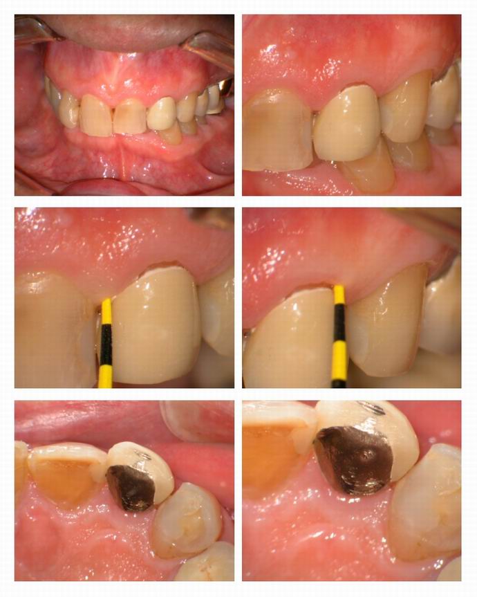 Resize of Osseous recontouring on lateral pg 1.jpg